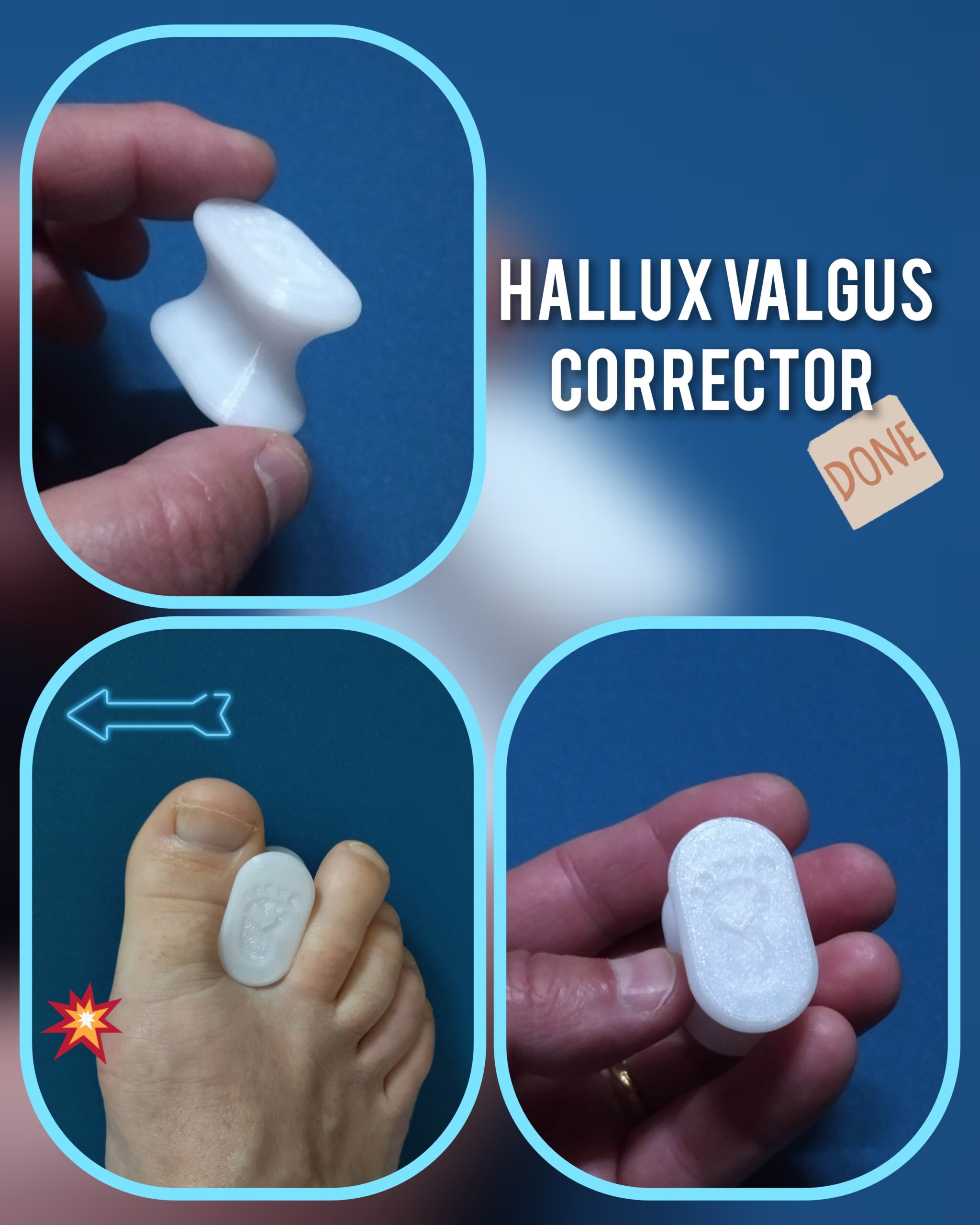 Écarteur correcteur d'orteils pour hallux valgus | 🦶Bien-être pied